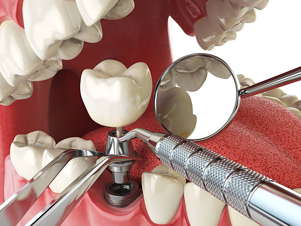 Best Emergency Root Canal Treatment in West Carrollton, OH